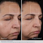 Obagi ELASTIderm Advanced Filler Concentrate koncentratas 20ml